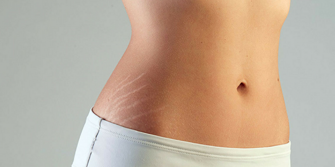 How To Get Rid Of Stretch Marks?