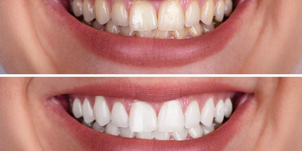 How Composite Bonding Can Improve Your Smile In Just One Day