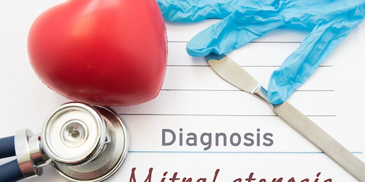 What Is Mitral Stenosis