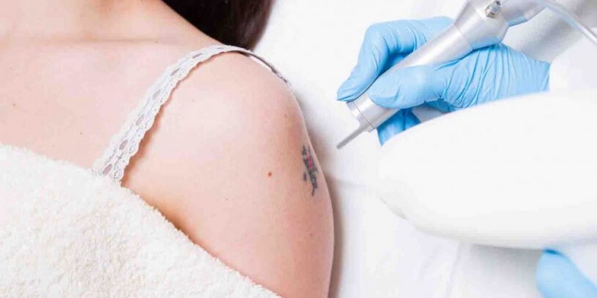 Frequently Asked Questions Before The Tattoo Removal Process