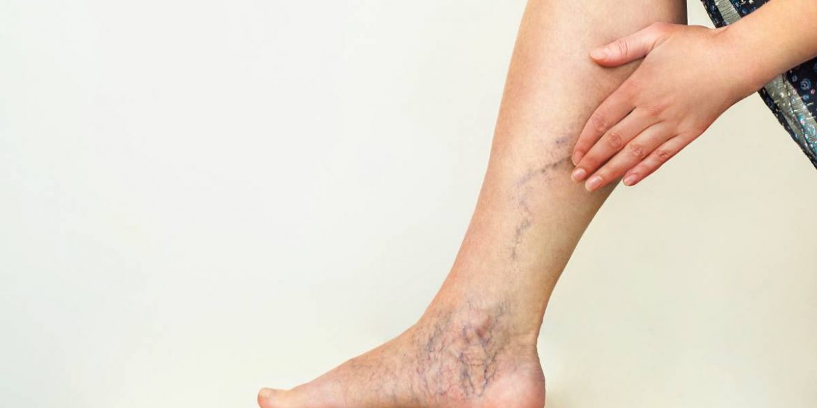 What To Consider Before Having Varicose vein Surgery