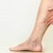 What To Consider Before Having Varicose vein Surgery